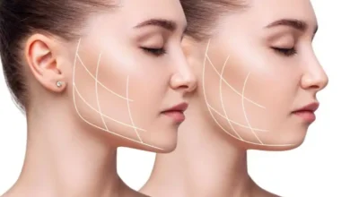 What is Jaw Filler and How is it Done