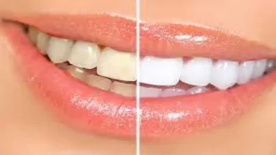What is Teeth Whitening Procedure